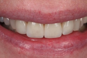 Dental Lab, e.max veneers