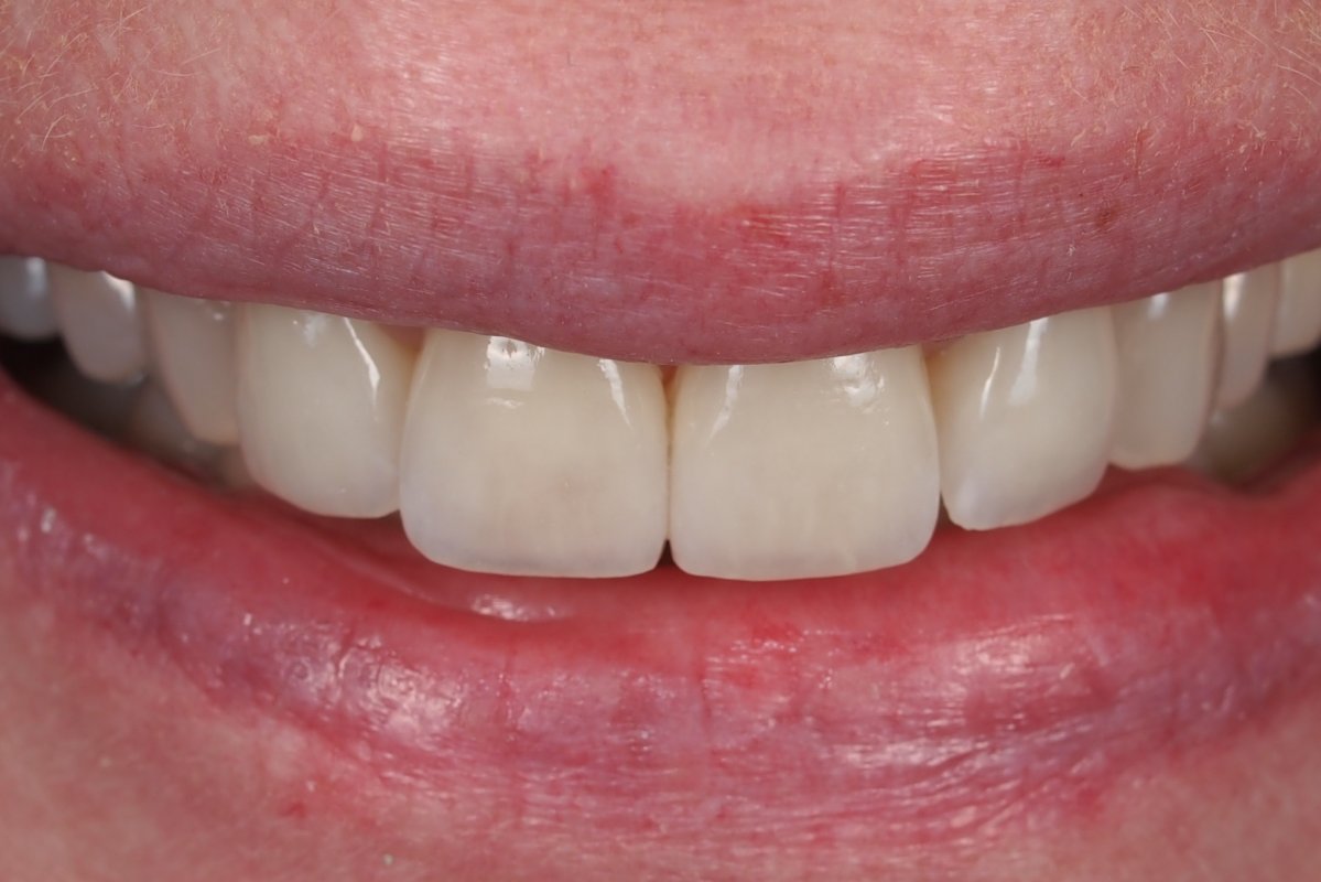 Case 13, e.max veneers 710 InHouse Dental Studio