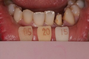 Dental Lab, e.max crown