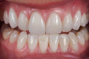 Dental Lab, Feldspathic Veneers