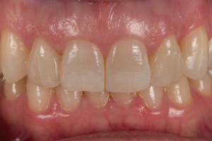 Feldspathic Veneers