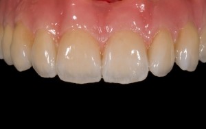 Implant supported fixed bridge