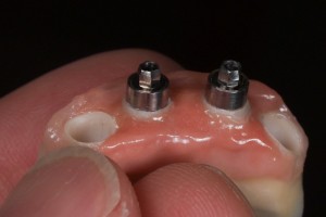 Dental Lab, Implant Supported Bridge.