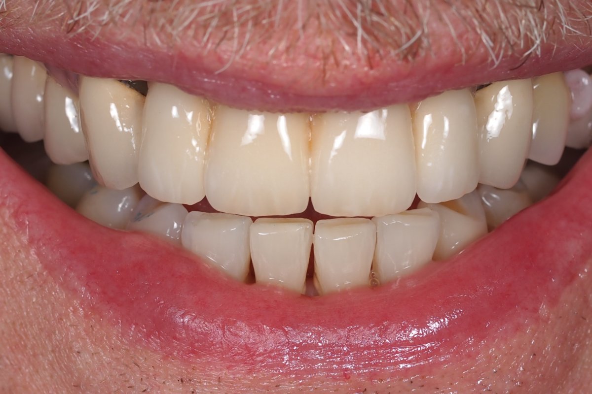 Case 12, Implant Supported Bridge 711 InHouse Dental Studio