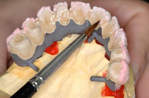 Implant supported fixed bridge