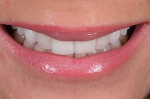 Dental Lab, Feldspathic Veneers