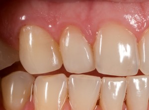 Feldspathic Veneers