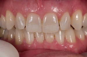 Feldspathic Veneers 