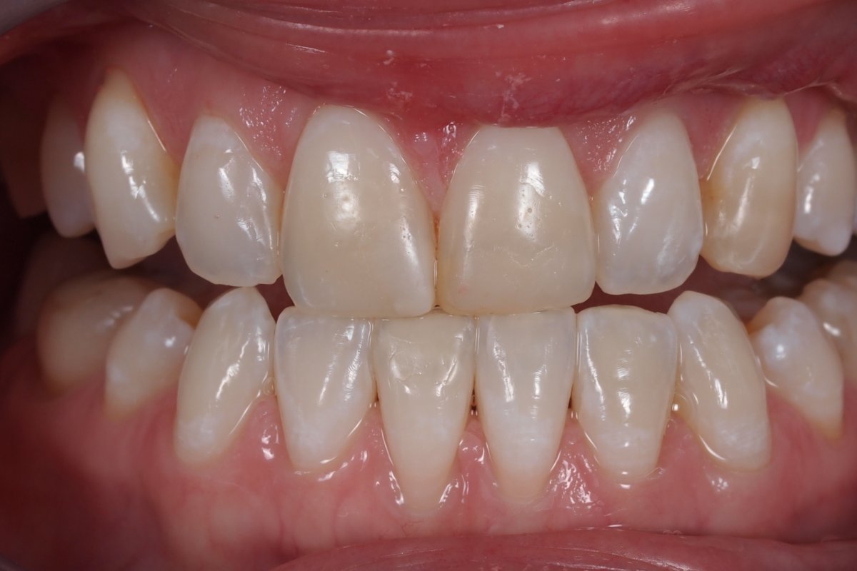 Case 14, Feldspathic porcelain veneers for teeth 6, 8, 9, and 11 In