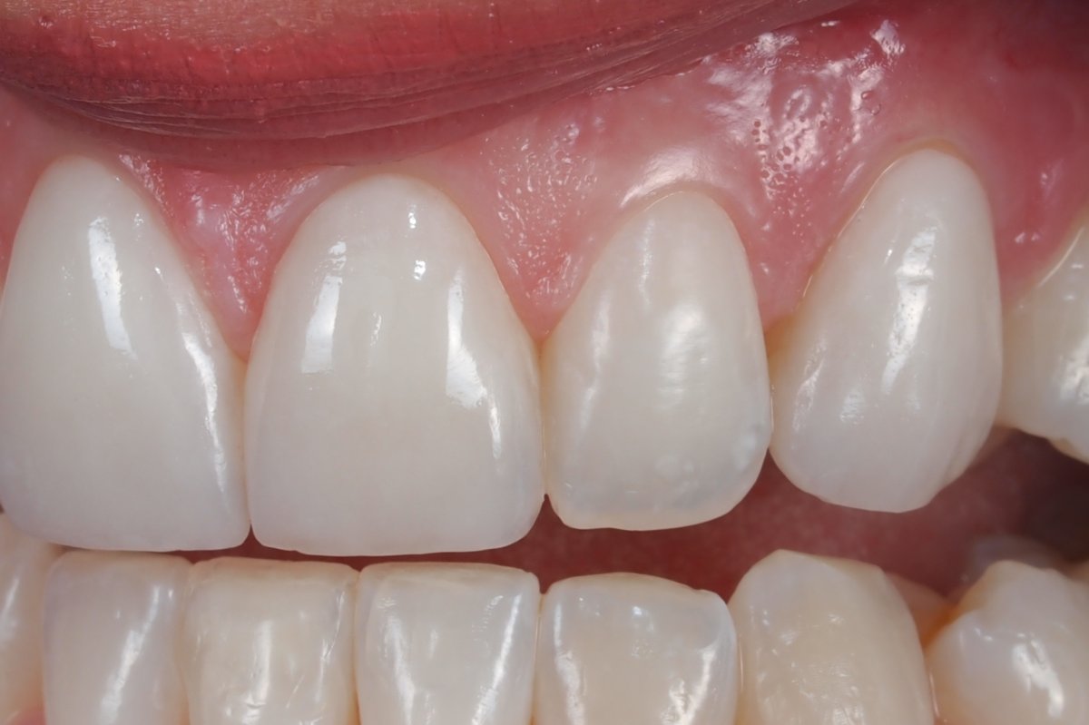 Case 14, Feldspathic porcelain veneers for teeth 6, 8, 9, and 11 In