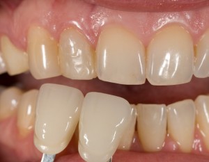 Feldspathic Veneers