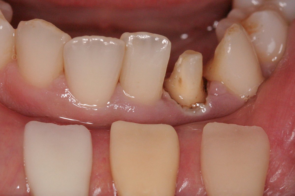 Case 15, e.max Layer Crown InHouse Dental Studio