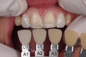 Dental Lab, Feldspathic Veneers