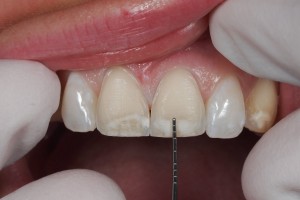 Dental Lab, Feldspathic Veneers