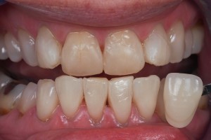 Dental Lab, e.max veneers 