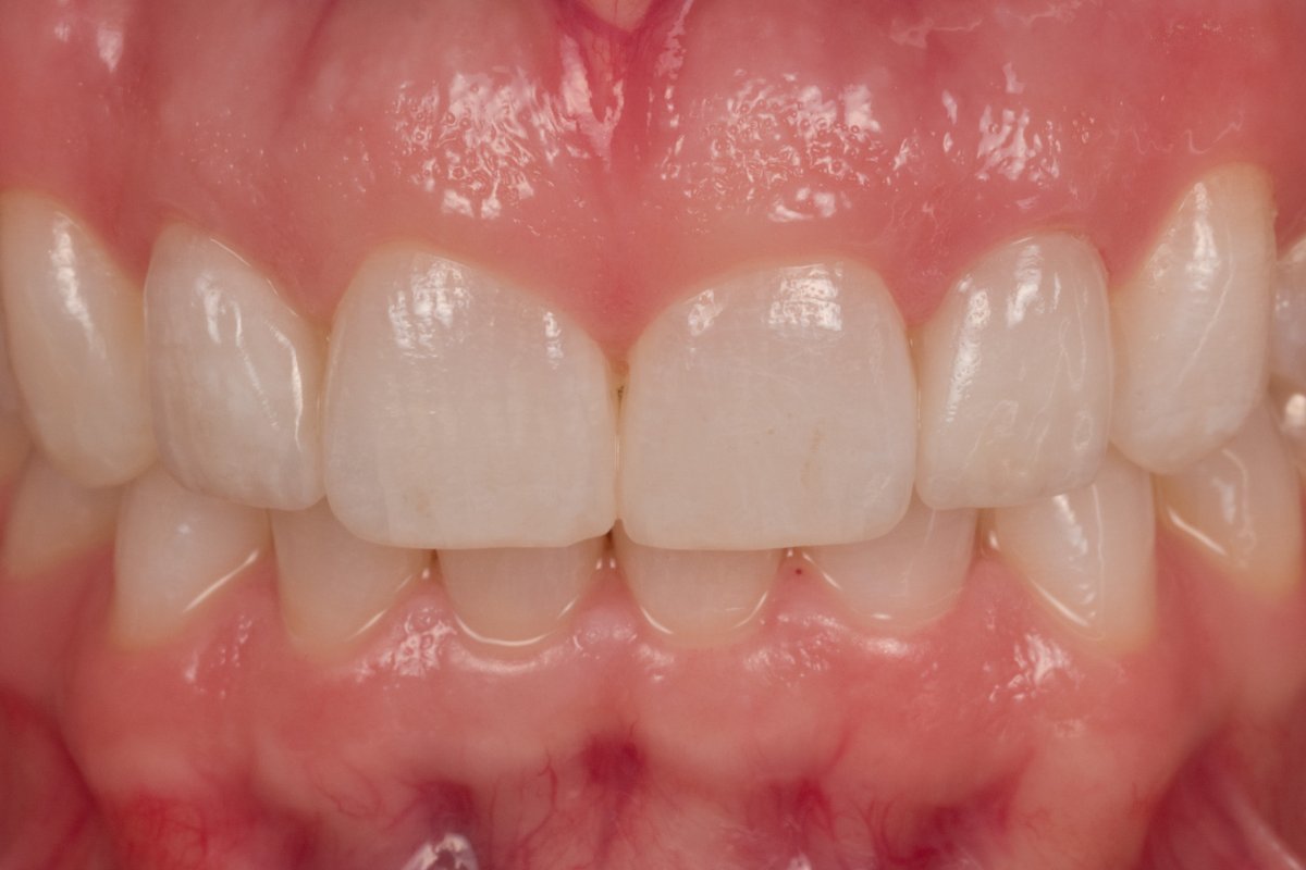 Case 4, Feldspathic Porcelain Veneers 7,10 InHouse Dental Studio