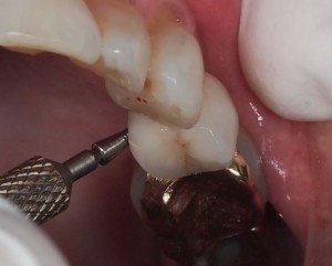 Screw Retained Implant Crown