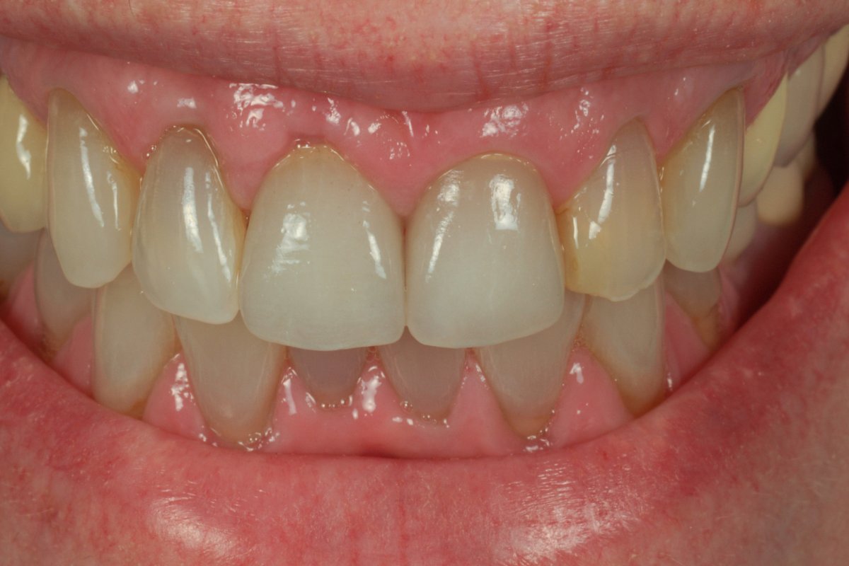 Case 6, Combination Case of Natural Tooth and Implant InHouse Dental