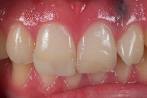 Dental Lab, Porcelain Veneers