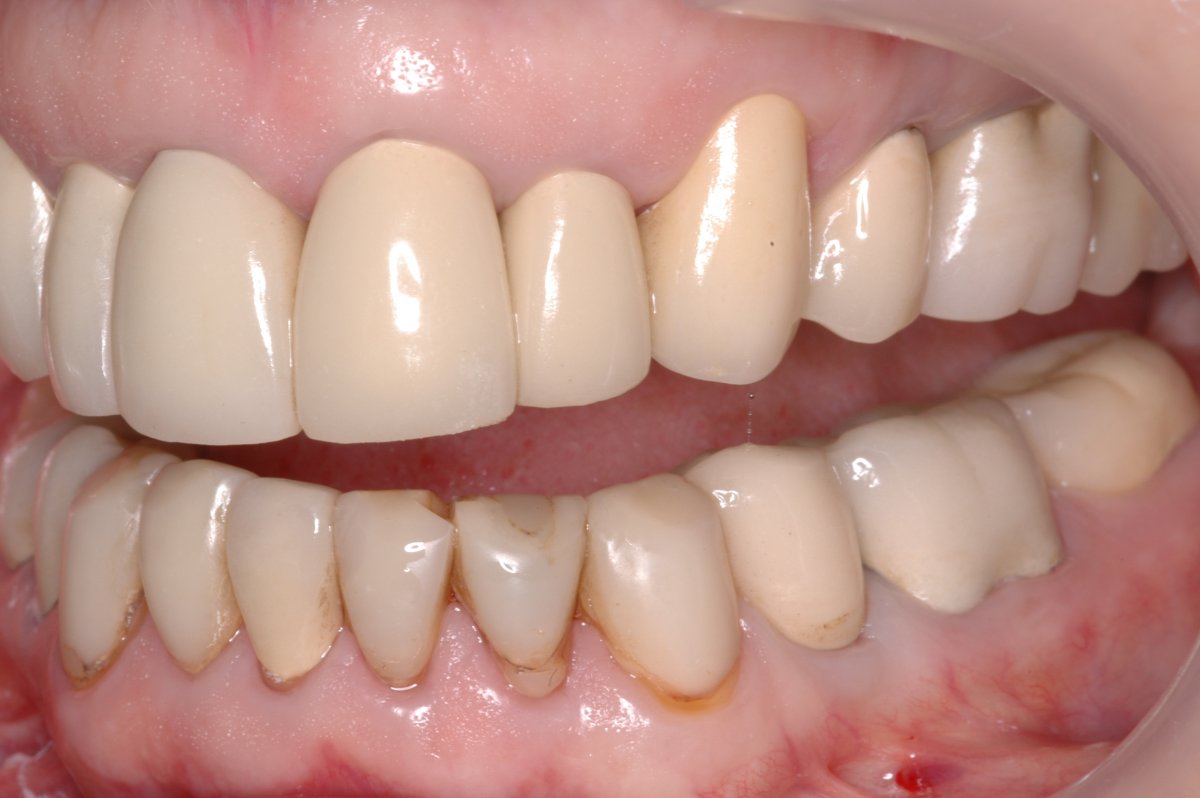 Case 3, Comprehensive Rehabilitation with Zirconia Crowns InHouse