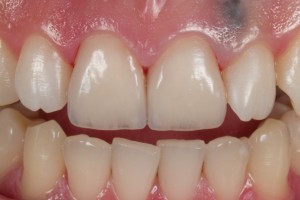 Dental Lab, Porcelain Veneers