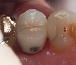 Screw Retained Implant Crown