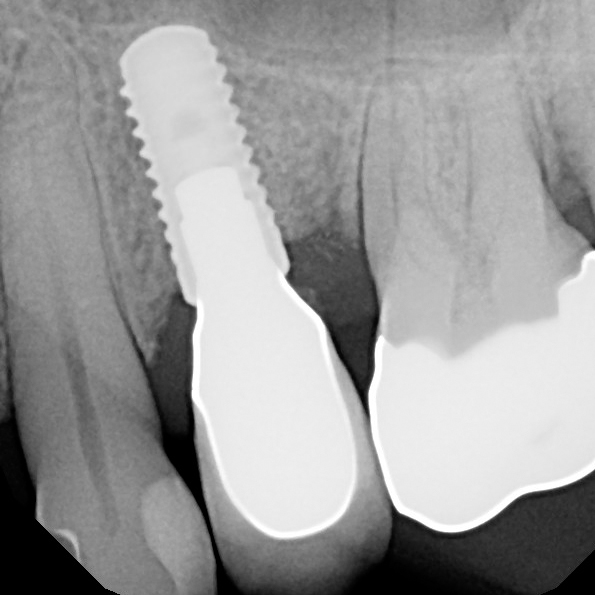 Case 11, Lingual set screw retained implant crown 13 InHouse Dental Studio