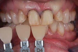 Dental Lab, e.max veneers 