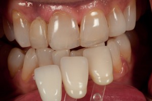 shade zirconia dental selection crown tooth crowns implant abutment porcelain retained creation standard case lab ivoclar tabs derived addition guides