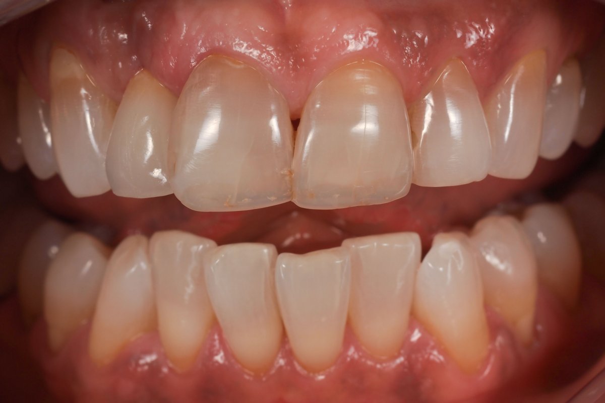 Case 5, Implant Retained Zirconia Abutment and Crown #7 | In-House