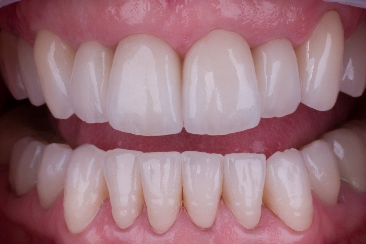 case 3 comprehensive rehabilitation with zirconia crowns in house zirconia crowns