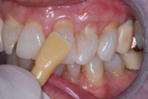 Screw Retained Implant Crown