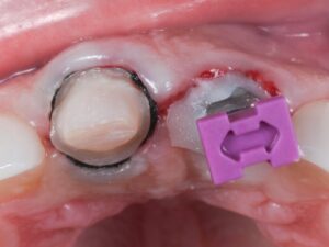 Dental Lab, Implant Crowns