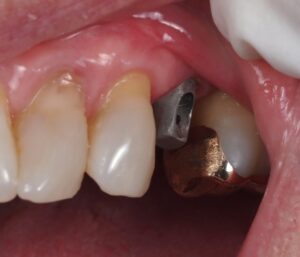 Screw Retained Implant Crown