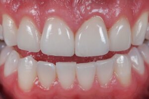 Dental Lab, Implant Crowns