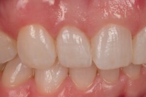 Dental Lab, Porcelain Veneers