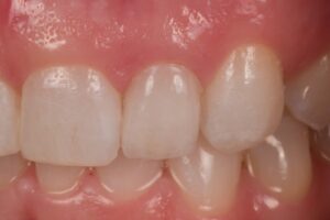 Dental Lab, Porcelain Veneers