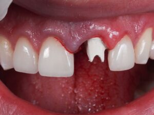 Dental Lab, Implant Crowns