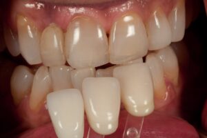 Dental Lab, Zirconia Crowns