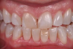 Dental Lab, Porcelain Crowns