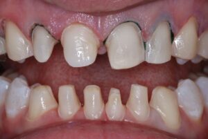 Dental Lab, Porcelain Crowns