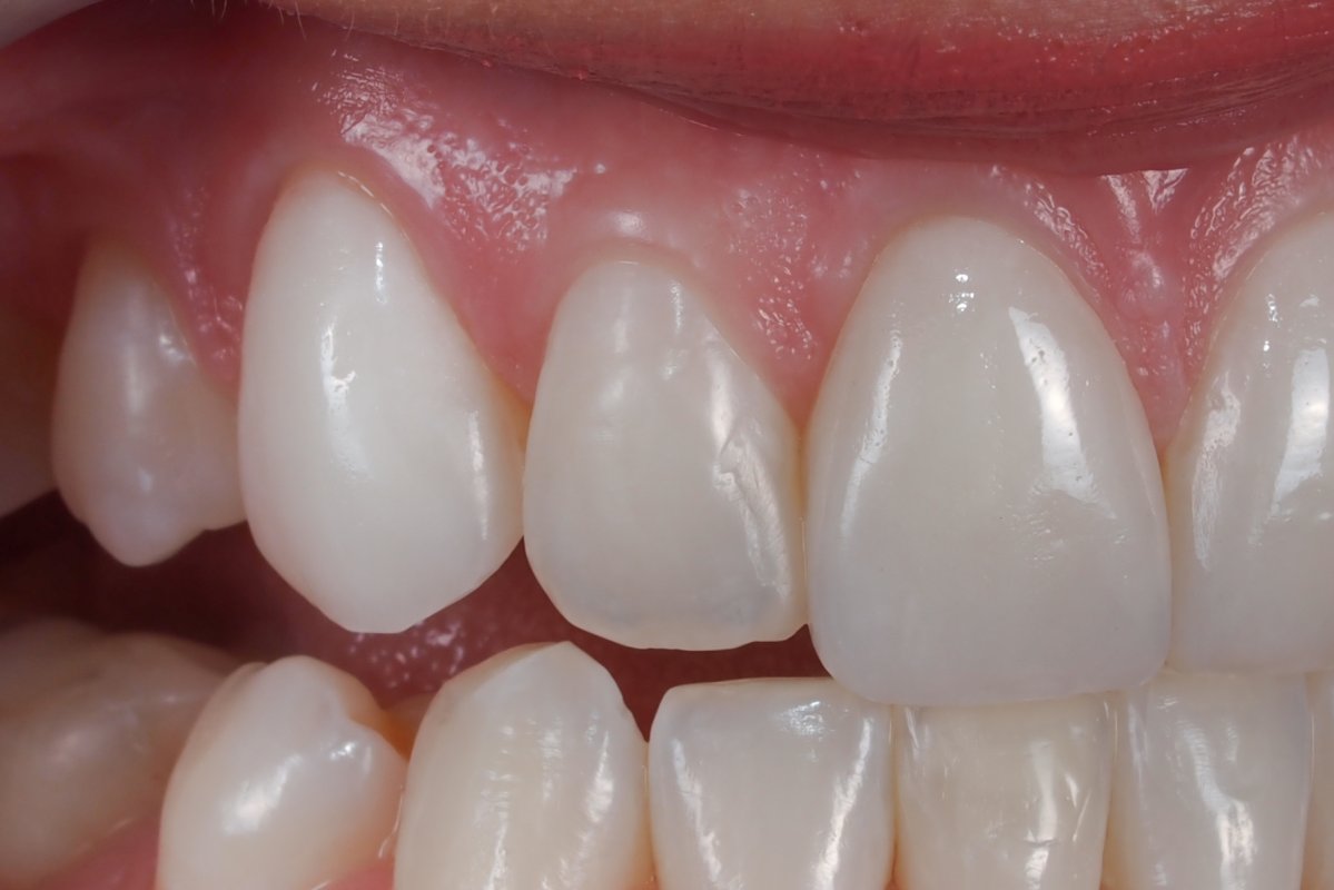 Case 14, Feldspathic porcelain veneers for teeth 6, 8, 9, and 11 In