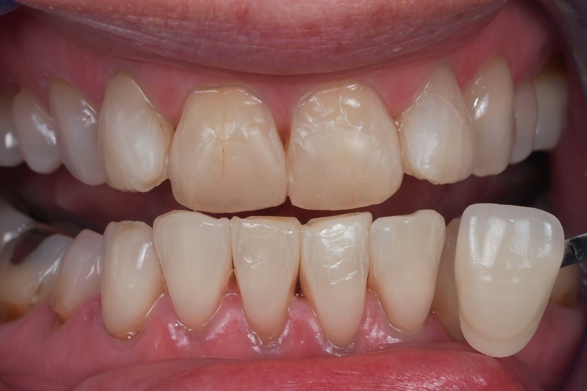 Case 13, e.max veneers 7-10 | In-House Dental Studio