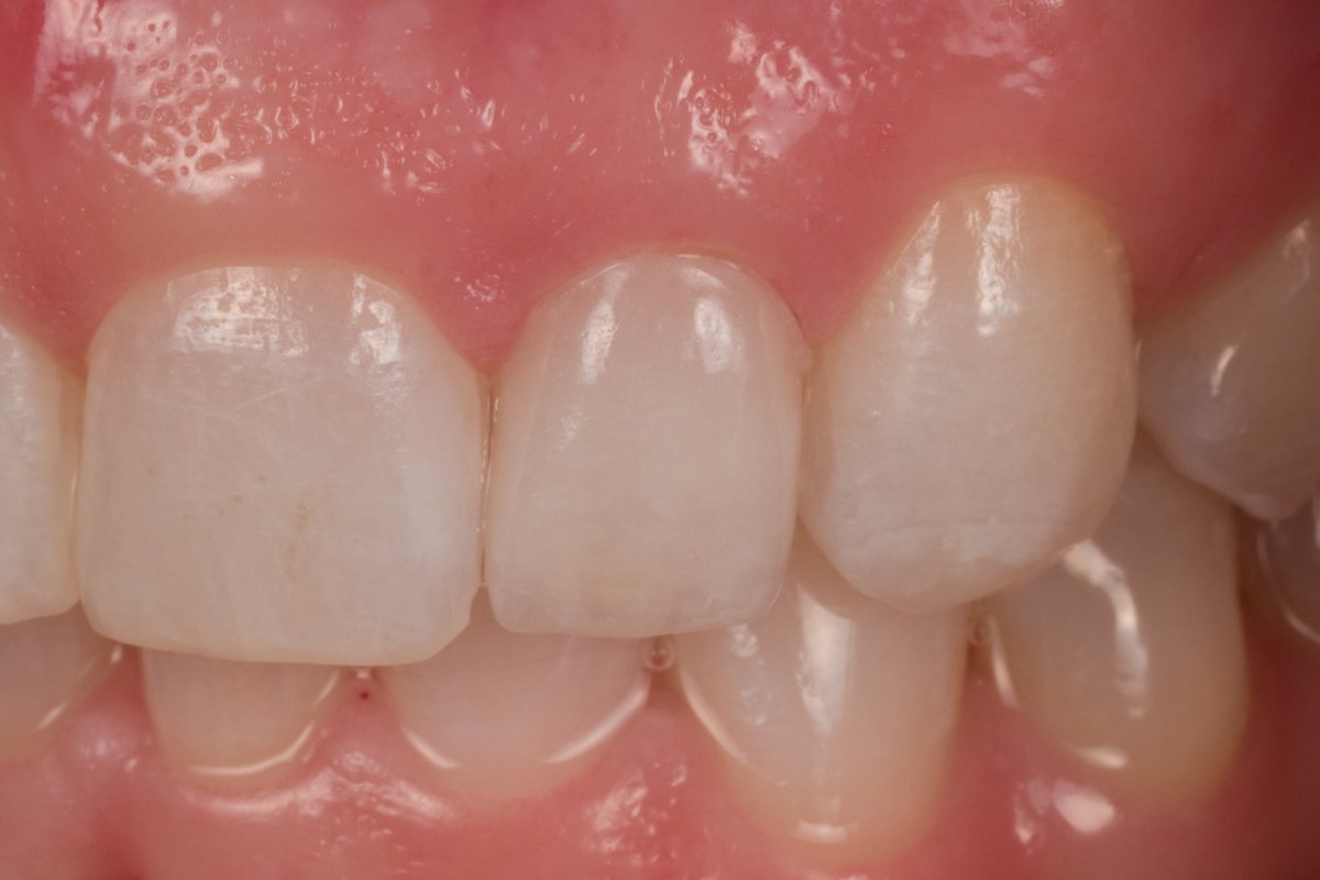 Case 4, Feldspathic Porcelain Veneers 7,10 InHouse Dental Studio