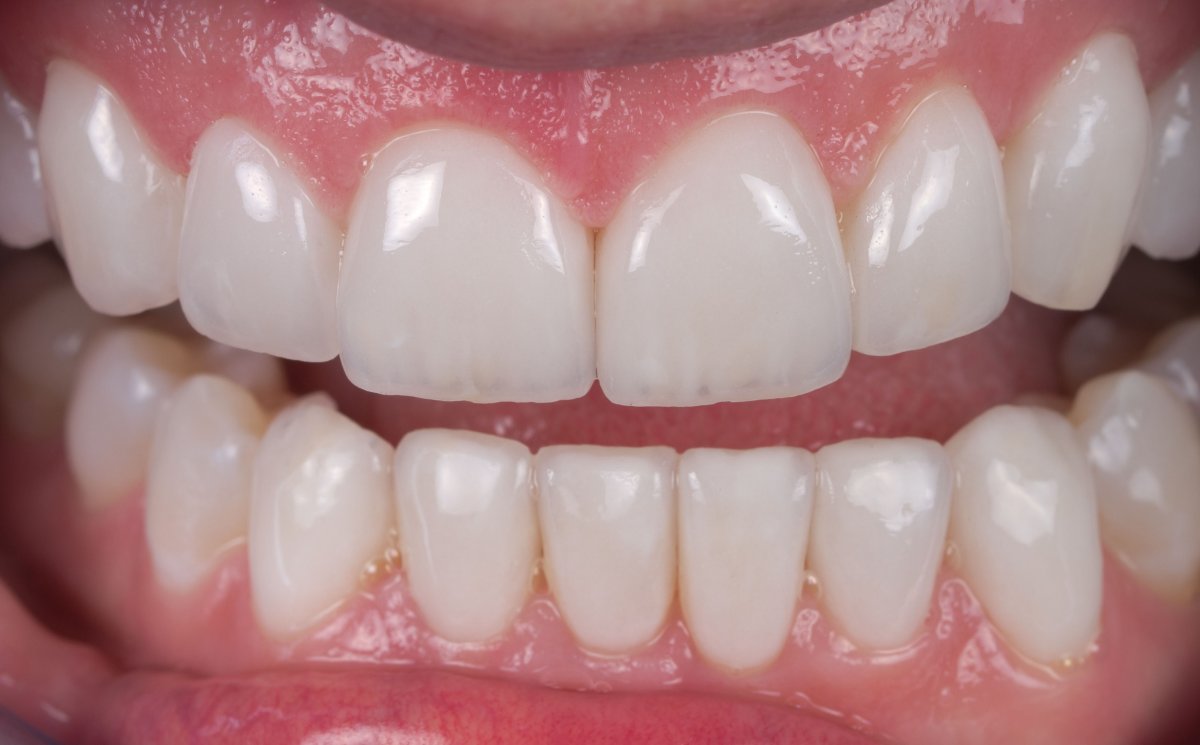 Case 16, Anterior Esthetic Makeover with Crowns, Veneers and Invisalign